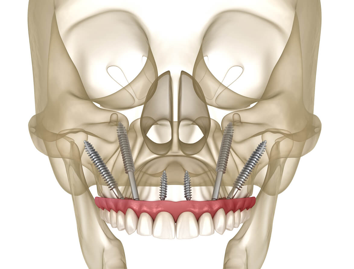 Fusion ZYGO Zygomatic